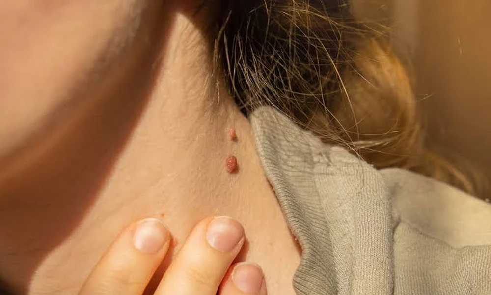What Patients Should Know Before Treating Unwanted Skin Growths